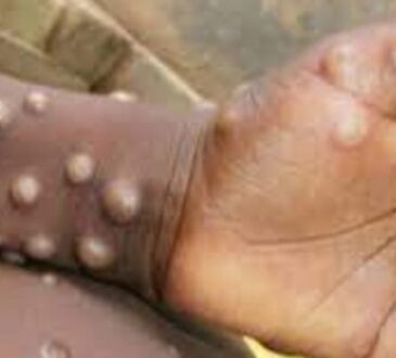 Ya está muy cerca: Confirman caso de viruela del mono en Iquique