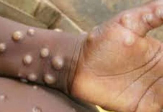 Ya está muy cerca: Confirman caso de viruela del mono en Iquique