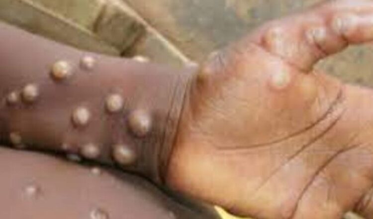 Ya está muy cerca: Confirman caso de viruela del mono en Iquique